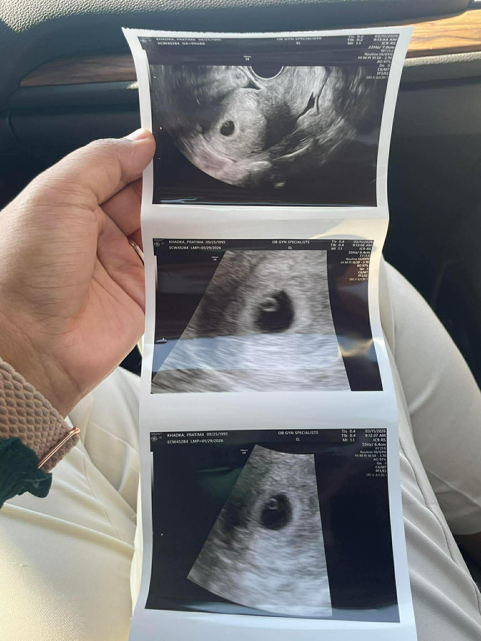 First B-Scan